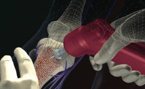 Arrow EZ-IO intraosseous vascular access needle sets – risk of needle stick injury IO