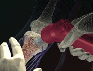 Intravenous versus intraosseous access in prehospital cardiac arrest 14 IO